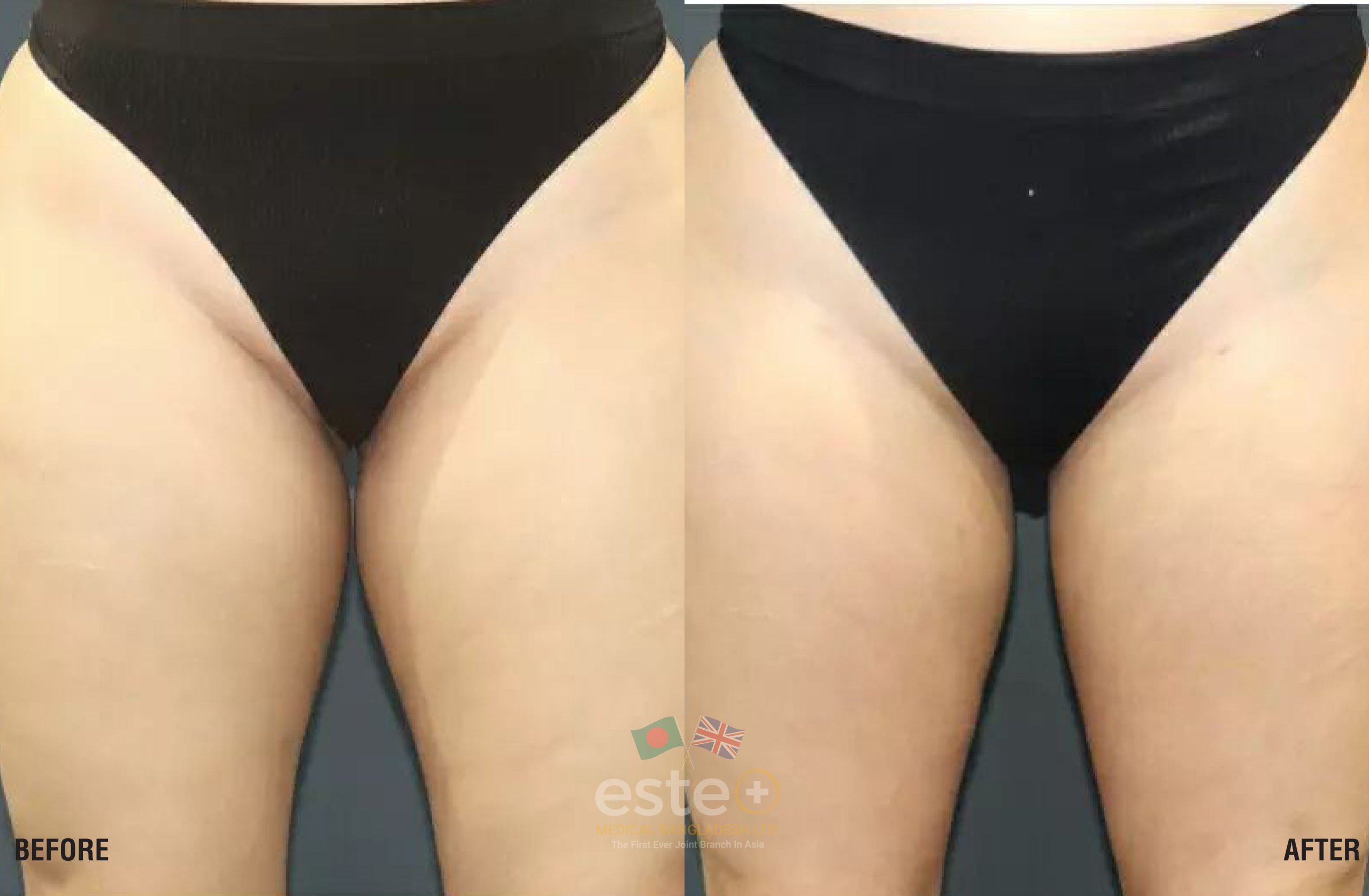 Coolsculpting INNER THIGHS