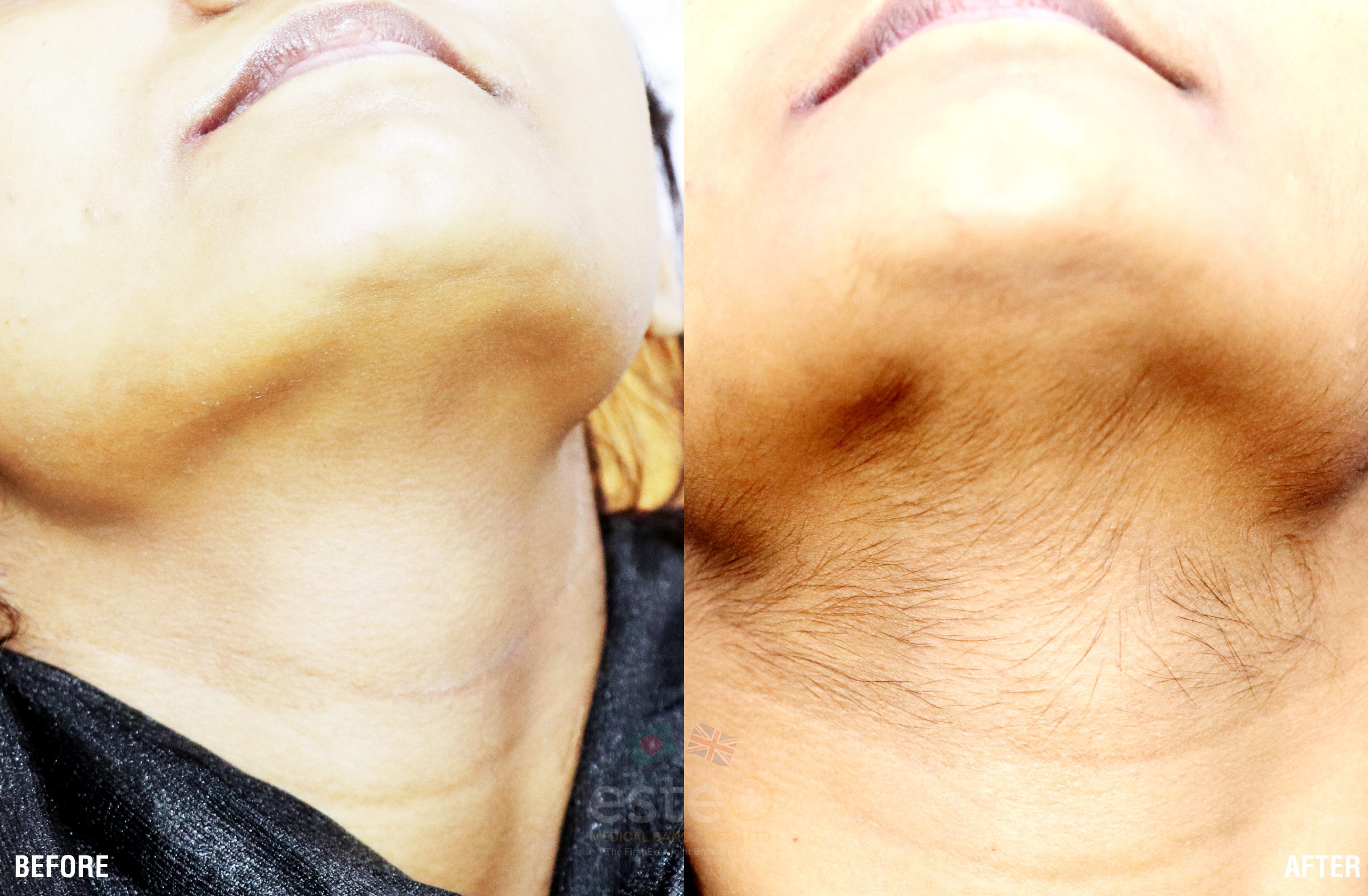 Laser Hair Removal 4-01