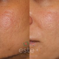 Acne / Acne Scarring